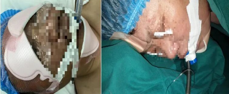 手术器械设备怎么读【文献解读】手术室器械相关压力性损伤预防的最佳证据总结_https://www.jmylbn.com_新闻资讯_第8张