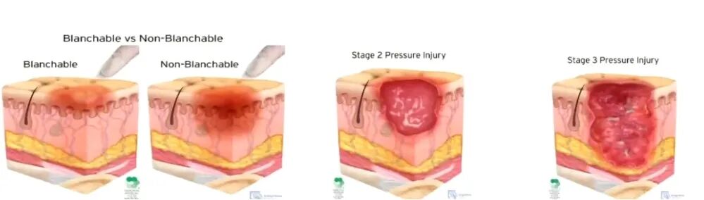 手术器械设备怎么读【文献解读】手术室器械相关压力性损伤预防的最佳证据总结_https://www.jmylbn.com_新闻资讯_第4张