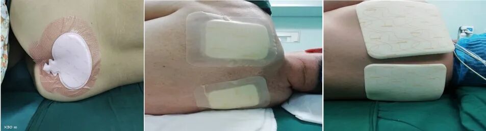 手术器械设备怎么读【文献解读】手术室器械相关压力性损伤预防的最佳证据总结_https://www.jmylbn.com_新闻资讯_第7张