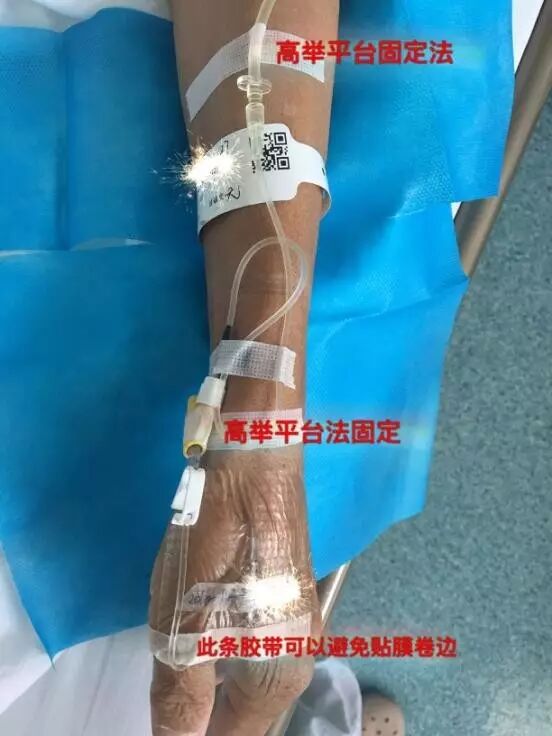 为什么叫正压留置针的临床小技巧：正压留置针固定方法_https://www.jmylbn.com_新闻资讯_第6张