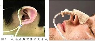 加强器官插管怎么用遇到非计划性拔管，这些经验方法能帮你解决！_https://www.jmylbn.com_新闻资讯_第4张