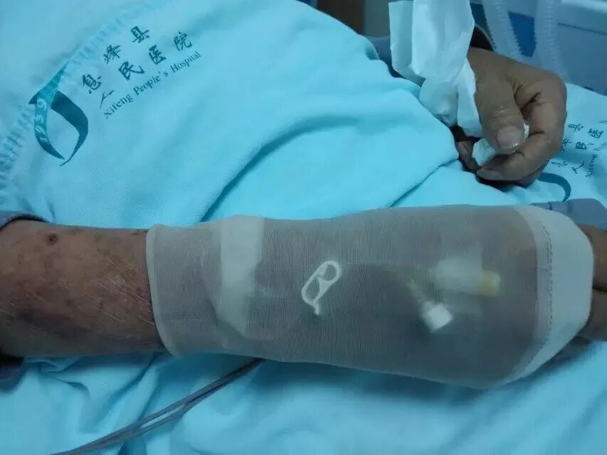 加强器官插管怎么用遇到非计划性拔管，这些经验方法能帮你解决！_https://www.jmylbn.com_新闻资讯_第6张