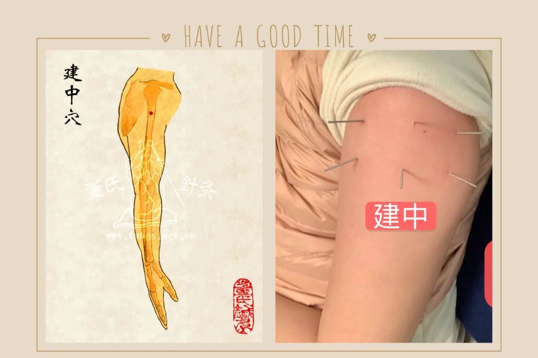 晋城正宗董氏奇穴针灸特色疗法培训