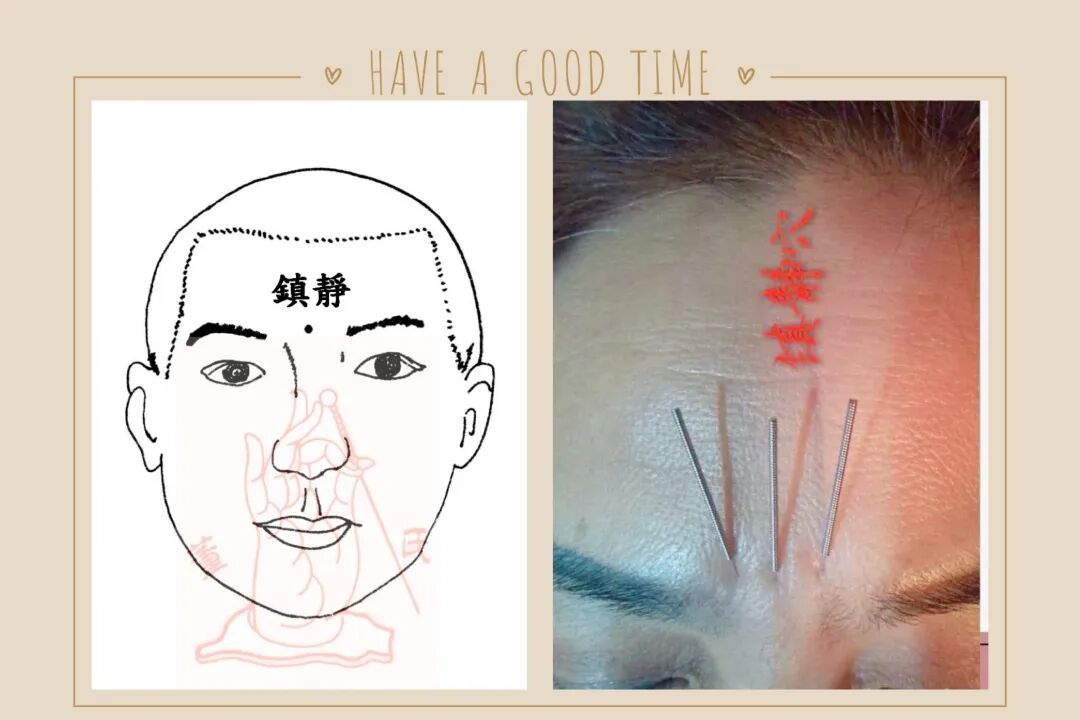 广宗董氏奇穴针灸培训基地失眠处方