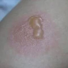 艾灸出现灸疮、晕灸怎么办？这些专业的处理办法，您真的知道吗？