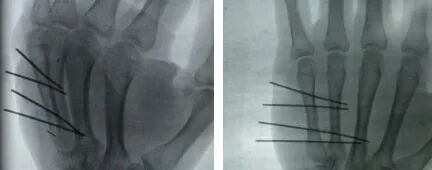 钛针是什么材料无切口——闭合复位钛针固定术治疗掌骨骨折_https://www.jmylbn.com_新闻资讯_第5张