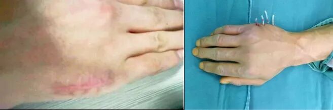 钛针是什么材料无切口——闭合复位钛针固定术治疗掌骨骨折_https://www.jmylbn.com_新闻资讯_第7张