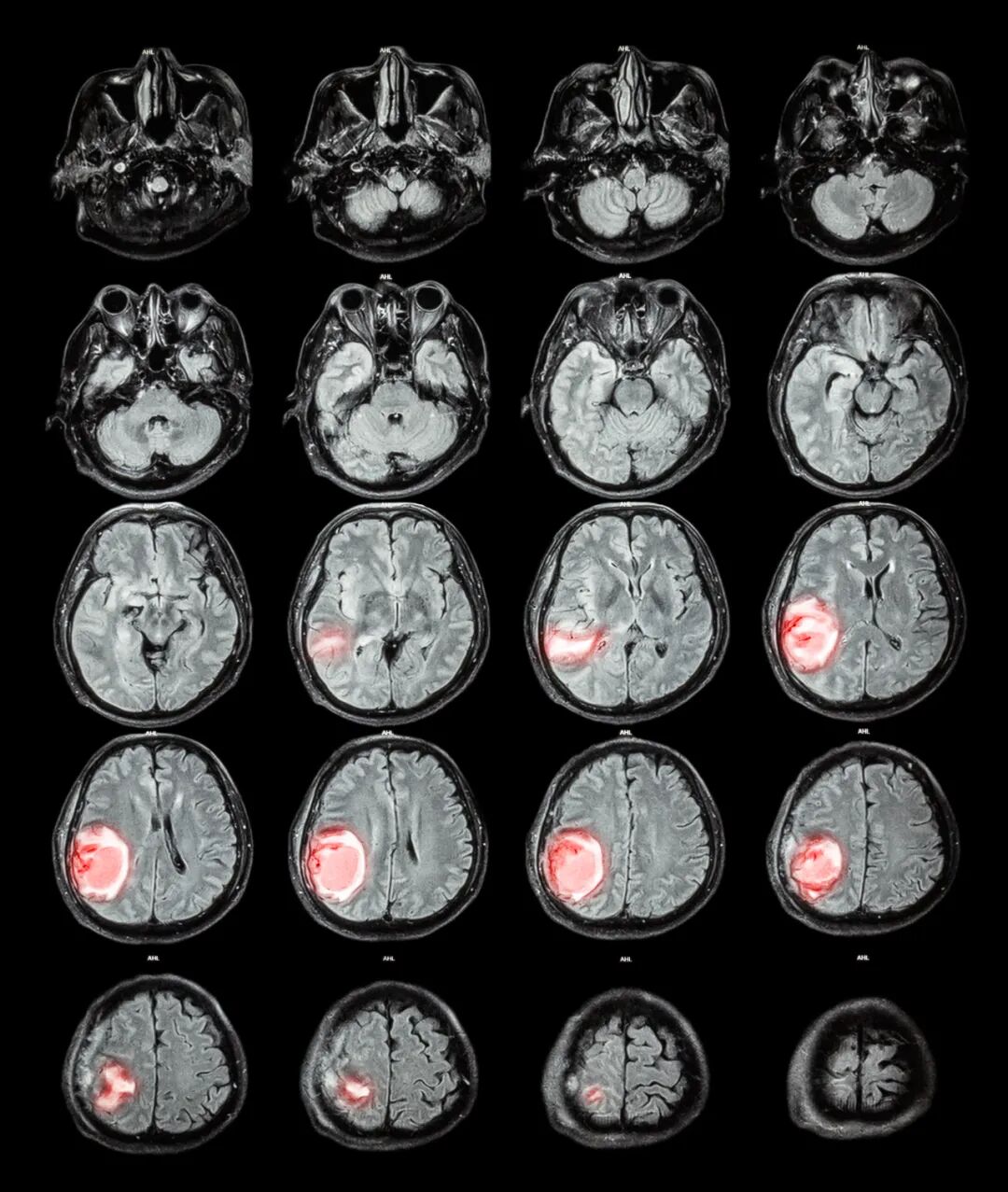 可愈有道_我有可能得了脑瘤