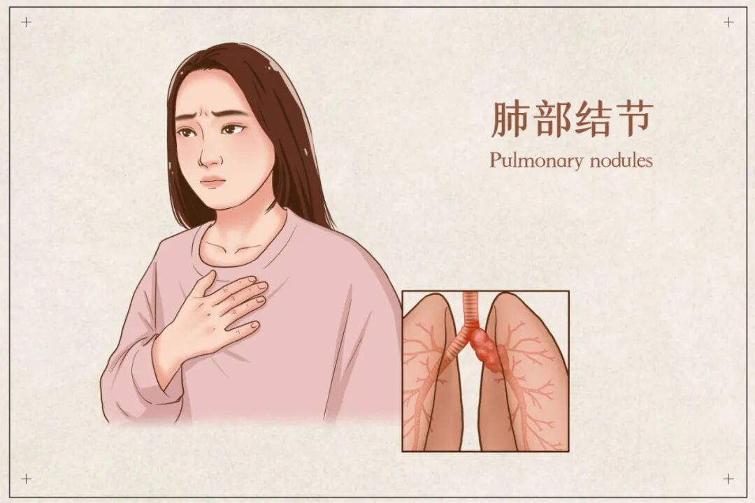 可愈有道_肺结节别不当回事，有这几个特征，小心数年后成肺癌
