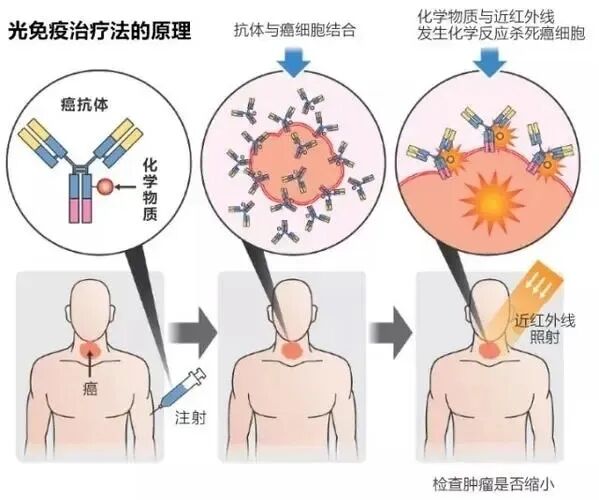硼中子俘获疗法