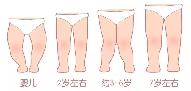 宝宝腿型的正常发育,就是一个从o型腿→正常腿型→ x型腿→正常腿型的