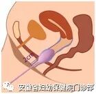 盆地康复仪器怎么用盆底肌肉康复器的使用方法~ 你掌握了吗？_https://www.jmylbn.com_新闻资讯_第8张