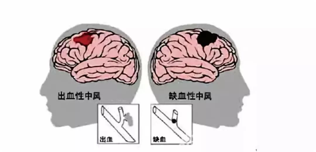 脑梗、心梗、脑中风等心脑血管人群，肽不可少！