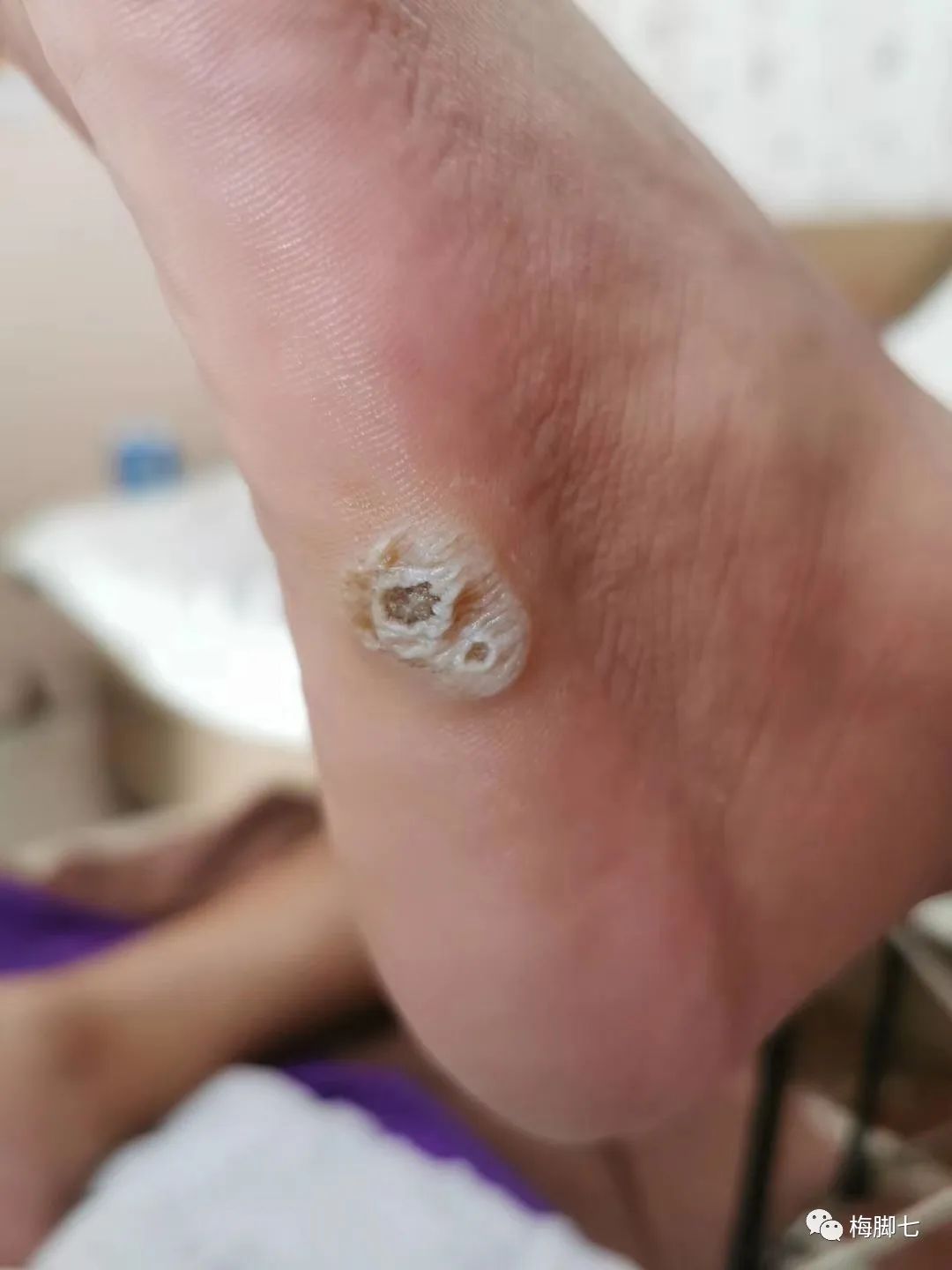什么是血胞刺？血胞刺和鸡眼的区别