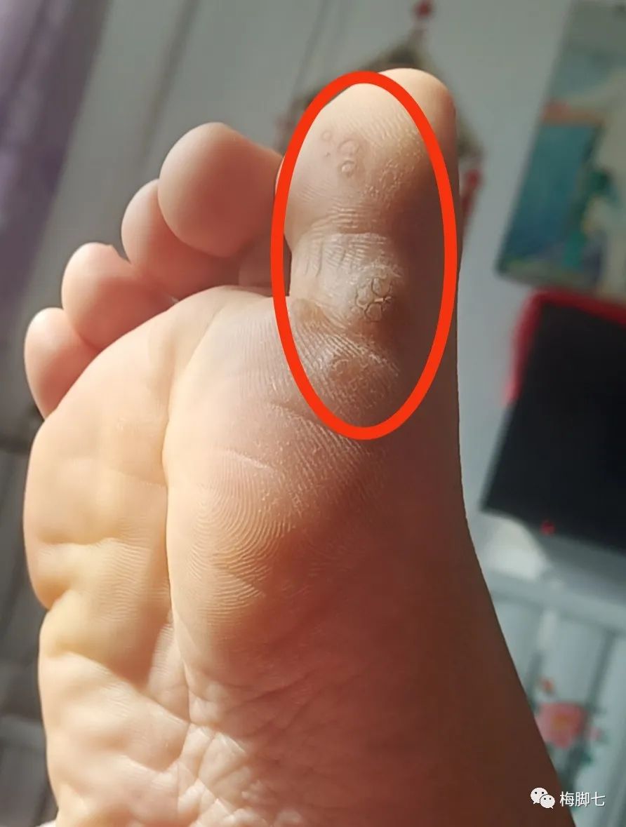 什么是血胞刺？血胞刺和鸡眼的区别