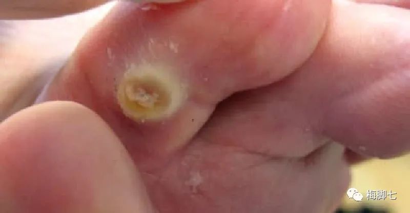 什么是血胞刺？血胞刺和鸡眼的区别