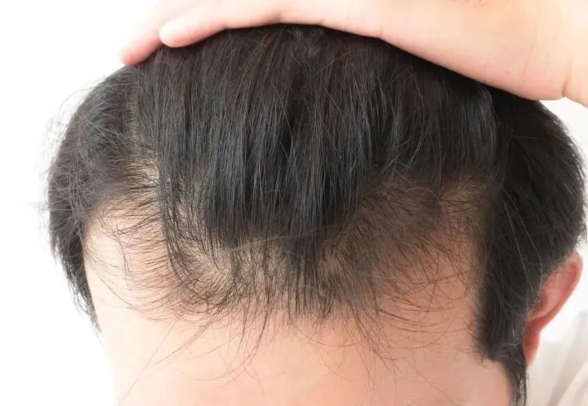 【毕节哪家医院治疗脱发好】青年掉发严重怎么解决_该如何改善？