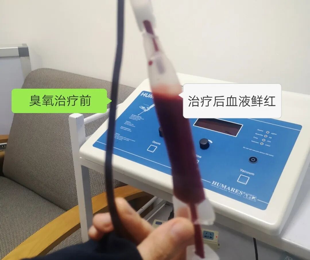 什么三氧输血解析神奇的“免疫三氧自体血回输疗法”-上海聚慕医疗器械有限公司