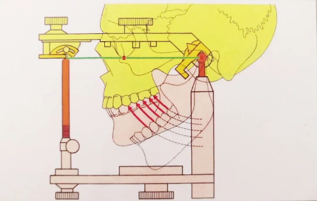 半可调颌架有哪些HE架模拟下颌运动的原理及常见分类_https://www.jmylbn.com_新闻资讯_第8张