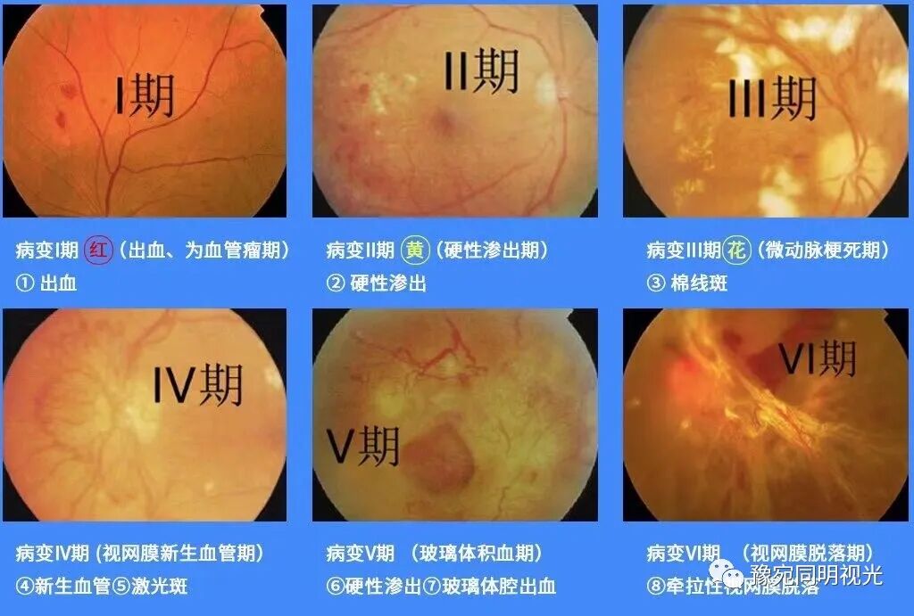 眼底激光机有什么牌子【高端设备】豫宛同明眼科医院引进瑞士美瑞激光治疗仪，进入眼底诊疗新时代_https://www.jmylbn.com_新闻资讯_第14张