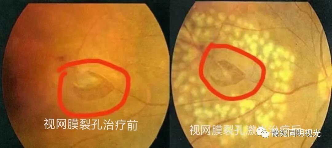 眼底激光机有什么牌子【高端设备】豫宛同明眼科医院引进瑞士美瑞激光治疗仪，进入眼底诊疗新时代_https://www.jmylbn.com_新闻资讯_第16张