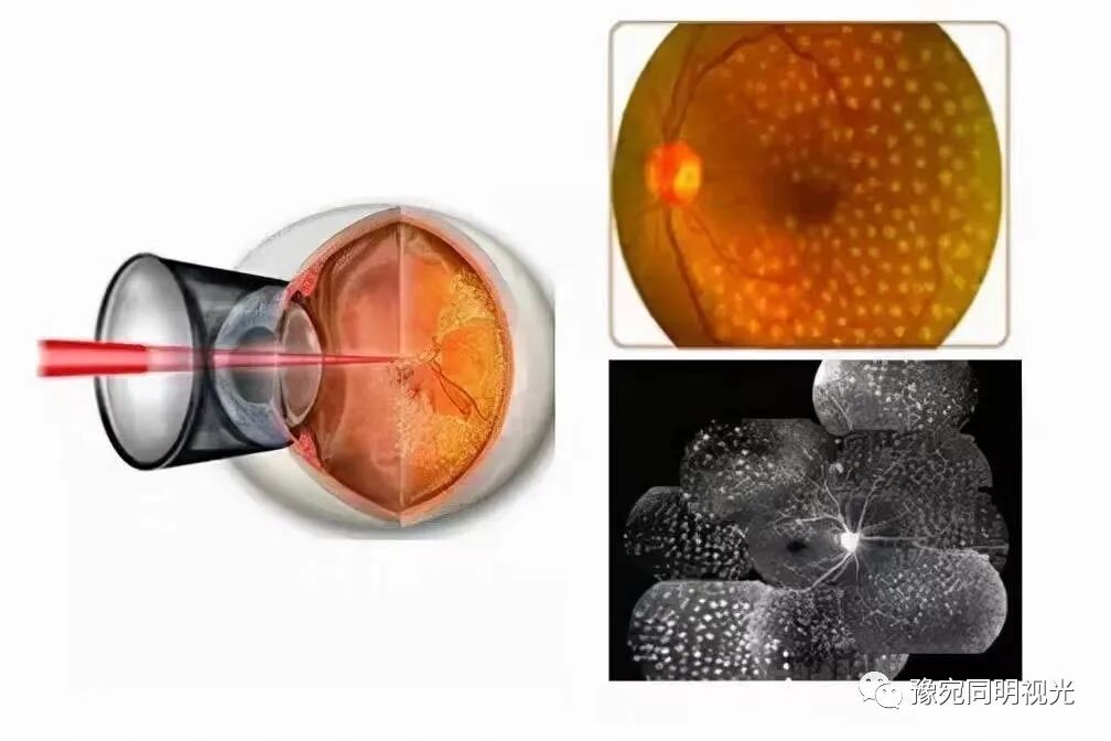 眼底激光机有什么牌子【高端设备】豫宛同明眼科医院引进瑞士美瑞激光治疗仪，进入眼底诊疗新时代_https://www.jmylbn.com_新闻资讯_第5张