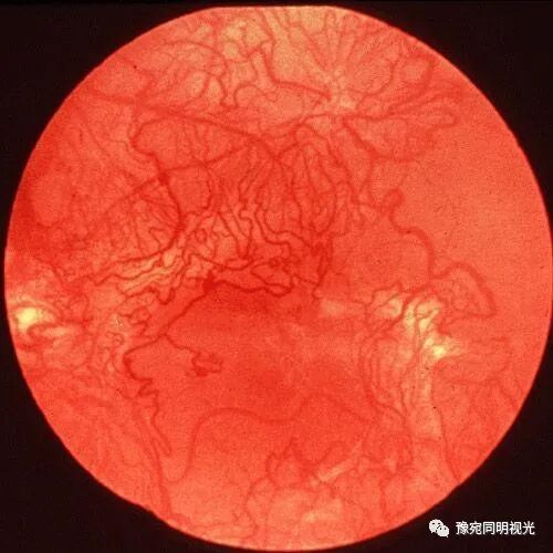 眼底激光机有什么牌子【高端设备】豫宛同明眼科医院引进瑞士美瑞激光治疗仪，进入眼底诊疗新时代_https://www.jmylbn.com_新闻资讯_第13张