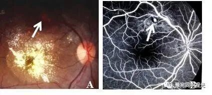 眼底激光机有什么牌子【高端设备】豫宛同明眼科医院引进瑞士美瑞激光治疗仪，进入眼底诊疗新时代_https://www.jmylbn.com_新闻资讯_第17张