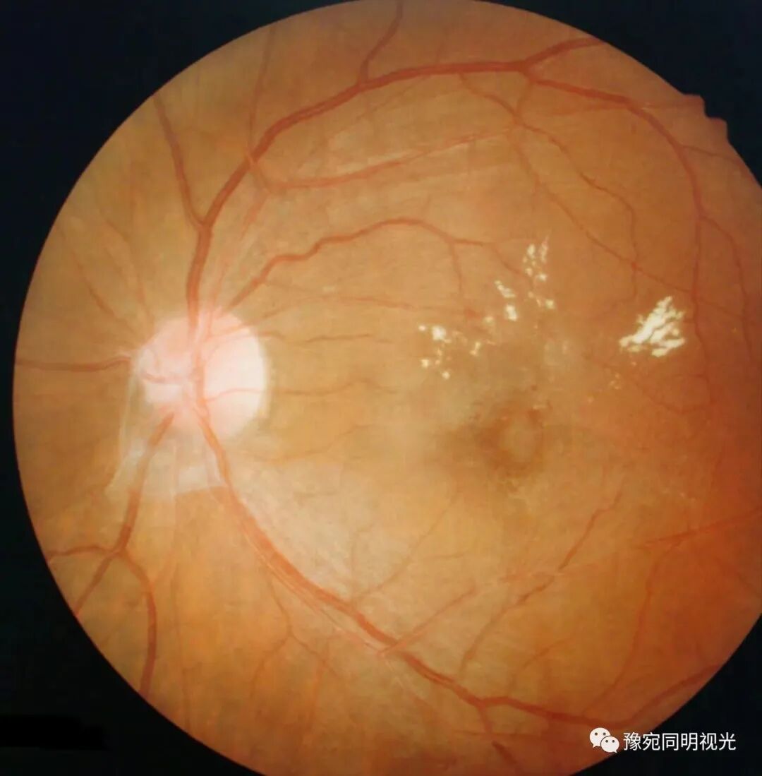 眼底激光机有什么牌子【高端设备】豫宛同明眼科医院引进瑞士美瑞激光治疗仪，进入眼底诊疗新时代_https://www.jmylbn.com_新闻资讯_第10张