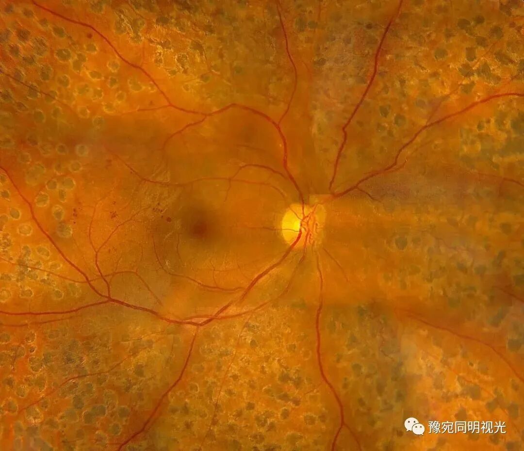 眼底激光机有什么牌子【高端设备】豫宛同明眼科医院引进瑞士美瑞激光治疗仪，进入眼底诊疗新时代_https://www.jmylbn.com_新闻资讯_第9张