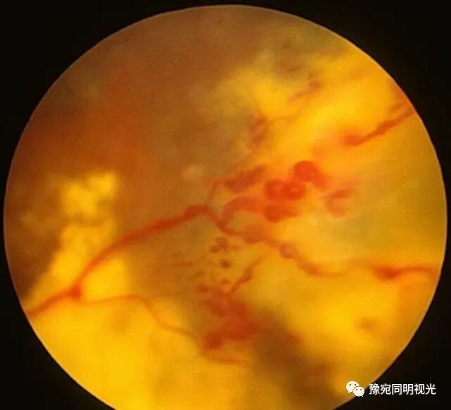 眼底激光机有什么牌子【高端设备】豫宛同明眼科医院引进瑞士美瑞激光治疗仪，进入眼底诊疗新时代_https://www.jmylbn.com_新闻资讯_第11张