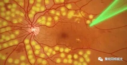 眼底激光机有什么牌子【高端设备】豫宛同明眼科医院引进瑞士美瑞激光治疗仪，进入眼底诊疗新时代_https://www.jmylbn.com_新闻资讯_第8张