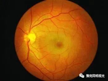 眼底激光机有什么牌子【高端设备】豫宛同明眼科医院引进瑞士美瑞激光治疗仪，进入眼底诊疗新时代_https://www.jmylbn.com_新闻资讯_第12张