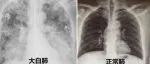 一直咳嗽，会变成“白肺”吗？哪些人需尽快做CT？