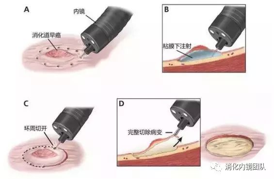 消化科完成大面积胃早癌内镜下粘膜切除术 消化内镜团队 微信公众号文章阅读 Wemp
