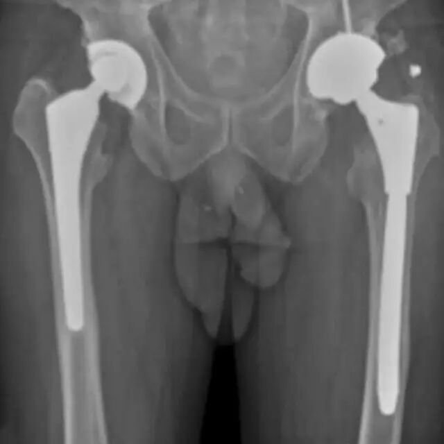 怎么取放射片研究--浅析下肢创伤中容易漏诊的X线片_https://www.jmylbn.com_新闻资讯_第27张