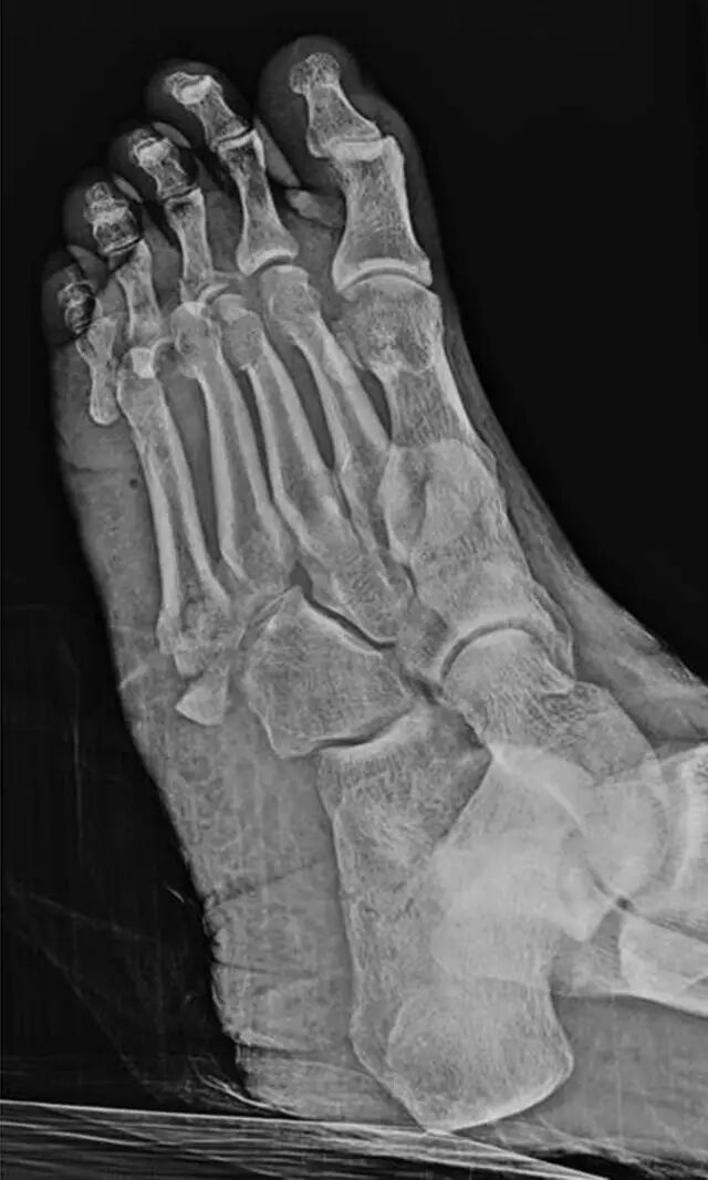 怎么取放射片研究--浅析下肢创伤中容易漏诊的X线片_https://www.jmylbn.com_新闻资讯_第23张