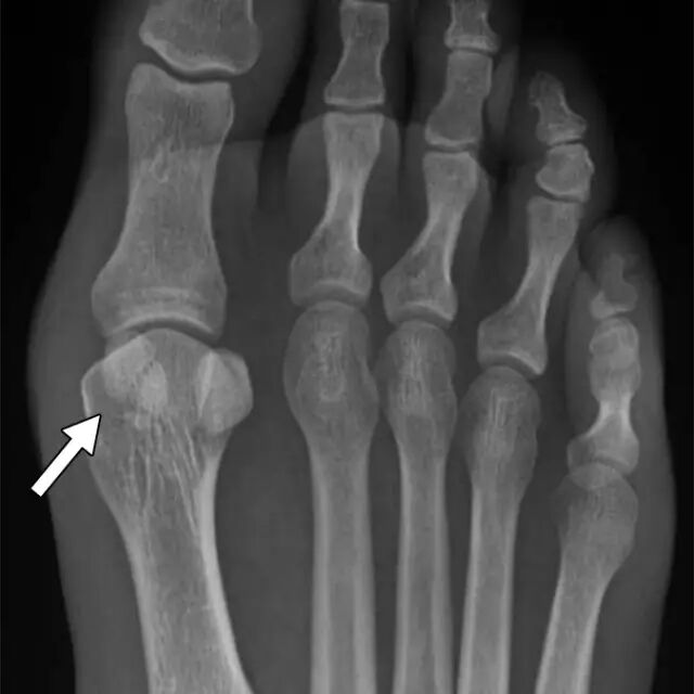 怎么取放射片研究--浅析下肢创伤中容易漏诊的X线片_https://www.jmylbn.com_新闻资讯_第22张