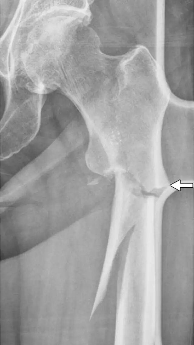 怎么取放射片研究--浅析下肢创伤中容易漏诊的X线片_https://www.jmylbn.com_新闻资讯_第25张