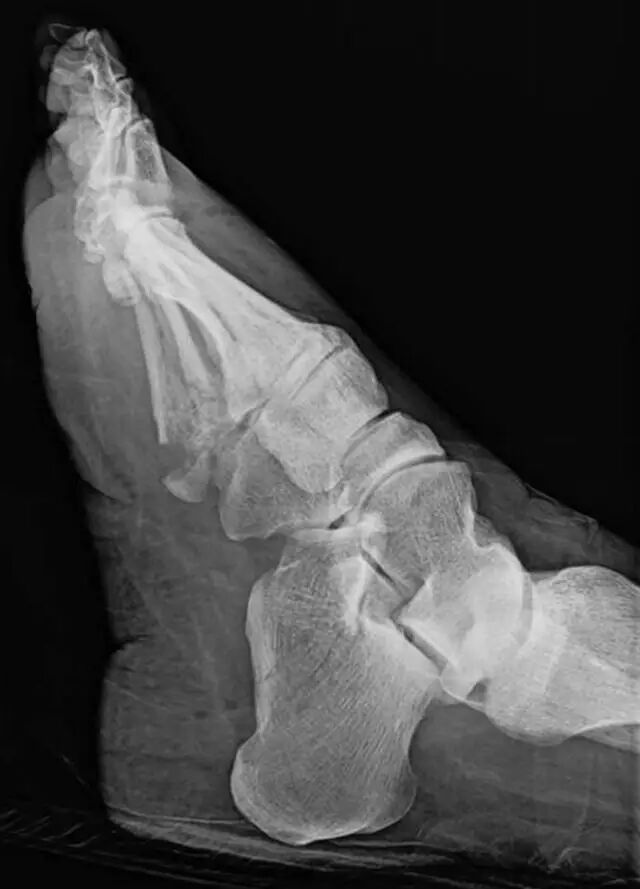 怎么取放射片研究--浅析下肢创伤中容易漏诊的X线片_https://www.jmylbn.com_新闻资讯_第24张