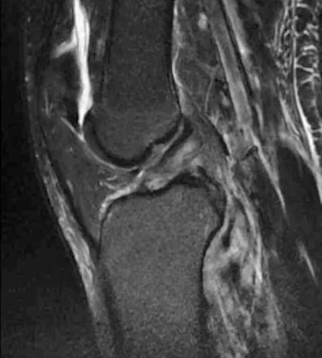 怎么取放射片研究--浅析下肢创伤中容易漏诊的X线片_https://www.jmylbn.com_新闻资讯_第21张