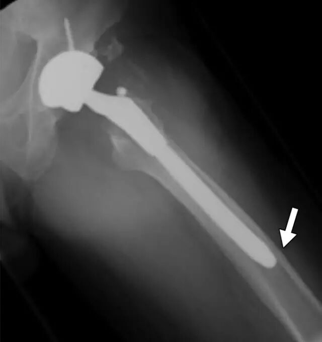 怎么取放射片研究--浅析下肢创伤中容易漏诊的X线片_https://www.jmylbn.com_新闻资讯_第28张