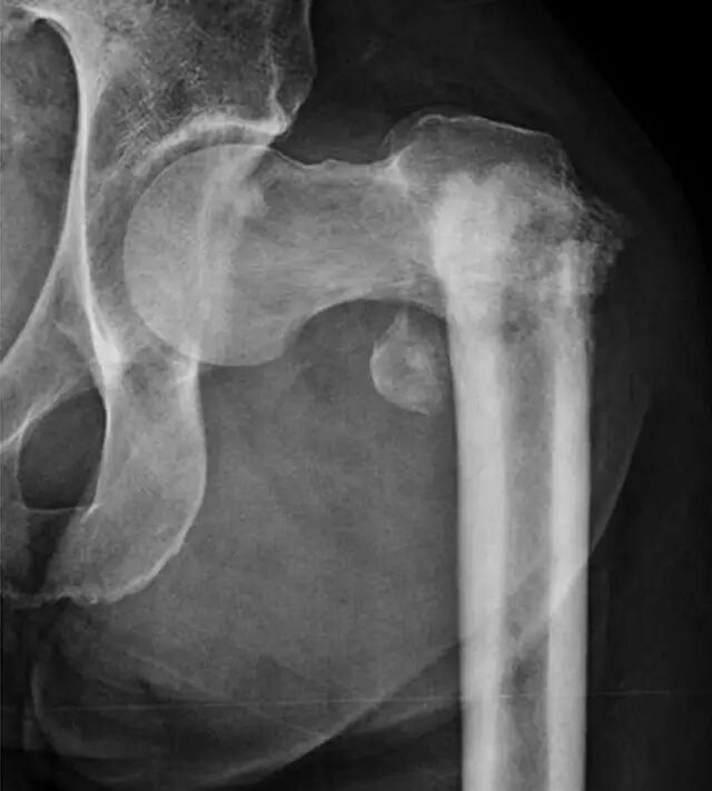 怎么取放射片研究--浅析下肢创伤中容易漏诊的X线片_https://www.jmylbn.com_新闻资讯_第26张