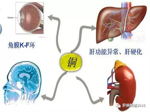 【科普】肝豆狀核變性患者應該怎麼治療