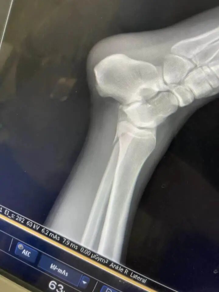 知名综艺录制现场突发意外！多人摔骨折，节目组不赔钱？