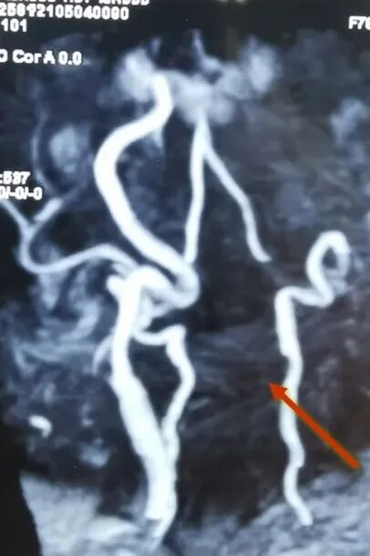 动脉长鞘怎么置入一鱼多吃，长鞘巧用抽吸术 ｜ 颈总动脉大负荷血栓取栓一例_https://www.jmylbn.com_新闻资讯_第5张