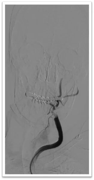 动脉长鞘怎么置入一鱼多吃，长鞘巧用抽吸术 ｜ 颈总动脉大负荷血栓取栓一例_https://www.jmylbn.com_新闻资讯_第17张