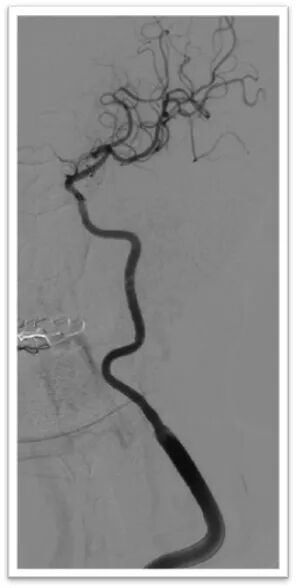 动脉长鞘怎么置入一鱼多吃，长鞘巧用抽吸术 ｜ 颈总动脉大负荷血栓取栓一例_https://www.jmylbn.com_新闻资讯_第30张