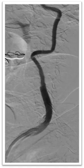 动脉长鞘怎么置入一鱼多吃，长鞘巧用抽吸术 ｜ 颈总动脉大负荷血栓取栓一例_https://www.jmylbn.com_新闻资讯_第22张