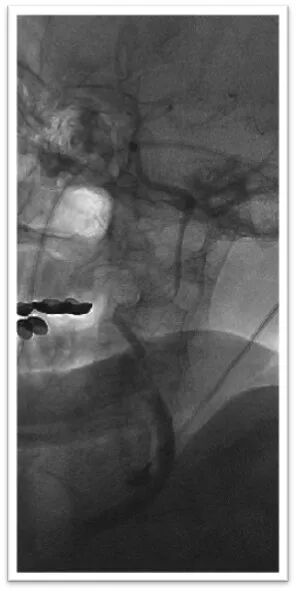 动脉长鞘怎么置入一鱼多吃，长鞘巧用抽吸术 ｜ 颈总动脉大负荷血栓取栓一例_https://www.jmylbn.com_新闻资讯_第20张